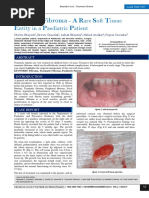 Traumatic Fibroma