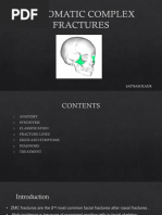 Zygomatic Complex Fractures