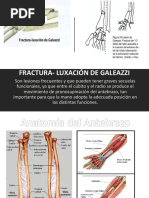 Fractura - Luxación de Galeazzi