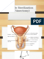 Male Sterilization