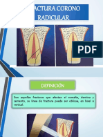 Fractura Corono-Radicular