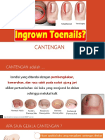 Cantengan (Ingrown Nail)