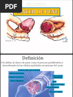 Cáncer de Pene