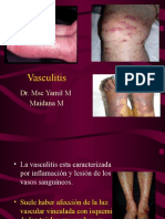 Vasculitis