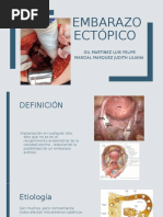 Embarazo Ectopico