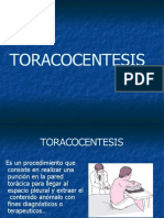 TORACOCENTESIS