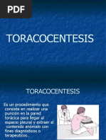 TORACOCENTESIS