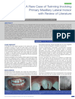 A Rare Case of Twinning Involving Primary Maxillary Lateral Incisor With Review of Literature