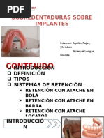 Sobredentaduras Sobre Implantes