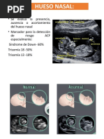 Hueso Nasal y Flujo Tricuspideo