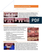 Planificación en Prótesis Fija
