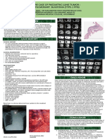 A Rare Case of Paediatric Lung Tumor: Pleuropulmonary Blastoma (Type-1 PPB)