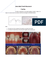 Palato-Labial Tooth Movement Z Spring: Uses