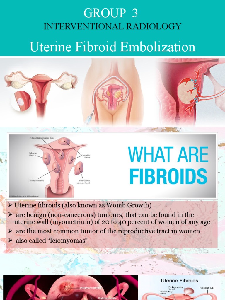 Uterine Fibroid Embolization | PDF | Interventional Radiology | Uterus