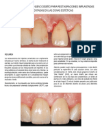 El "Pilar Híbrido": Un Nuevo Diseño para Restauraciones Implantadas Cementadas en Las Zonas Estéticas