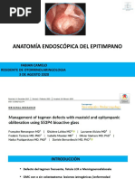 Anatomía Endoscópica Del Epitimpano