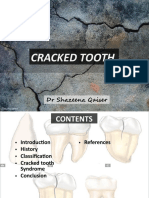 Cracked Tooth Syndrome