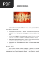 Recesión Gingival