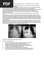 Caso Clinico Tuberculosis