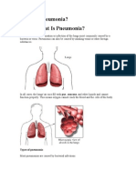 What Is Pneumonia