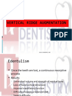 Vertical Ridge Augmentation