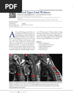 Bilateral Upper Limb Weakness: Sivakumar Vadivalagianambi and Venkatraman Indiran