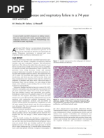 Adult Still's Disease and Respiratory Failure in A 74 Year Old Woman