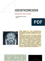 Cisticercosis - Neurocisticercosis