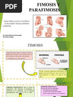 Fimosis y Parafimosis