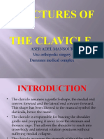 Fractures of Clavicle Aser