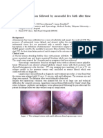 Adenomyosis Excision Followed by Successful Live Birth After Three Consecutive IVF