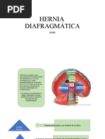 Hernia Diafragmática 