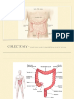 Colectomy - : A Colectomy Is Surgery To Remove Either All or Part of The Colon