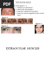 Extraocular Nerve Palsy