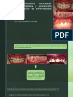 Periodontitis Ulcerativa Necrosante.