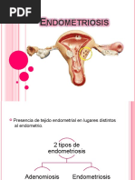 Endometriosis