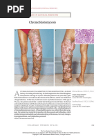 Brown NEJM Chromoblastomycoses