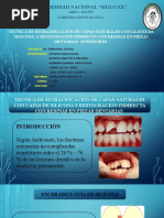 Técnica de Estratificación de Capas Naturales Con Llave de Silicona y Restauración Indirecta Con Resinas en Piezas Anteriores