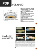 Gambaran Gonioskopi + Shaffer Grading