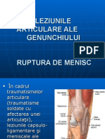 Ruptura de Menisc