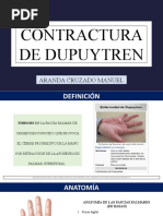 Contractura de Dupuytren