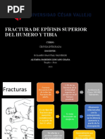 Fractura de Epifisis Superior de Humero y Tibia - Paredes Lescano