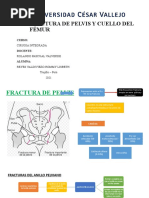 Fractura de Pelvis y Cuello de Femur - Reyes Valdiviezo Rommy