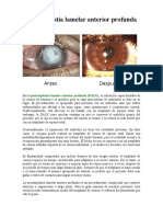 Queratoplastia Lamelar Anterior Profunda