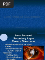 Lens Induced Glaucomas: Saleh Al Obeidan, MD