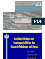 Cavilhas Elásticas No Tratamento Das Fracturas Dos Ossos Do Antebraço Na Criança. Pedro Simas, Carolina Escalda, Craveiro Lopes