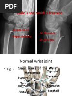 Colle's and Smith's Fracture: Prepared by Ali Nassser Supervised by DR - Ali Taha