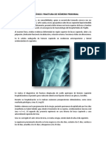 Caso Clínico - Fractura de Húmero Proximal