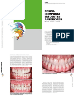 Resina Composta em Dentes Anteriores