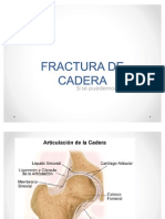 Fractura de Cadera